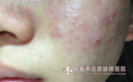 痤疮的并发症