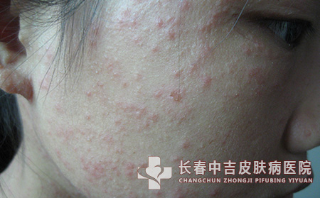 诱发痤疮的因素