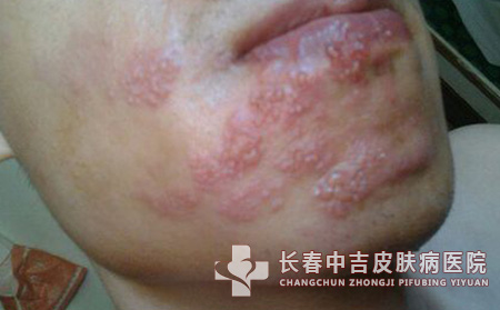 单纯疱疹治疗