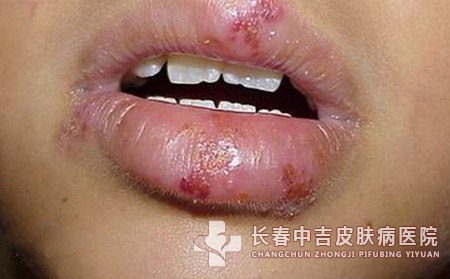 单纯疱疹