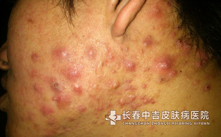白头粉刺怎么治疗