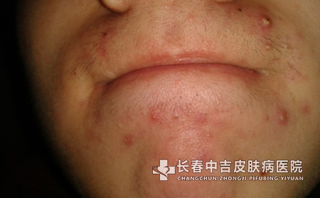 治疗痤疮的其他方