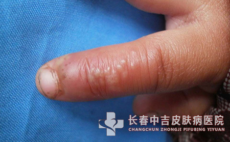 单纯疱疹