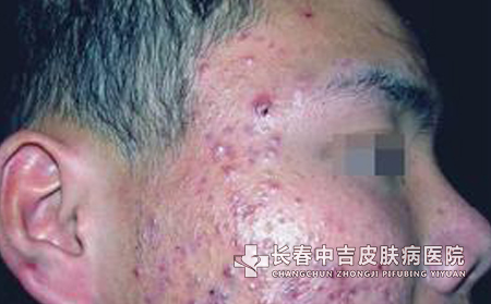 痤疮治疗的要点