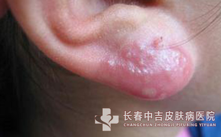 单纯疱疹