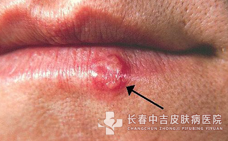 单纯疱疹