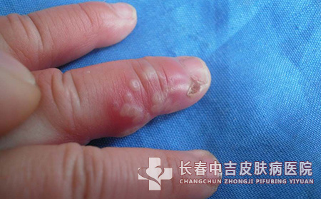 疱疹症状