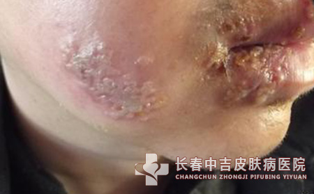 单纯疱疹