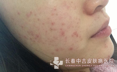 如何远离痘痘?