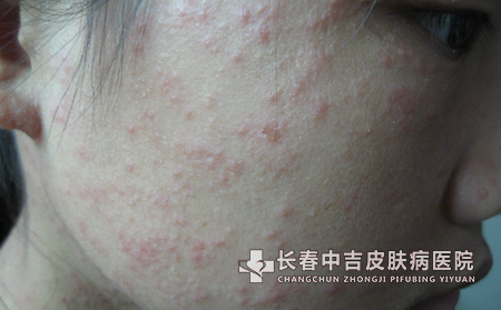 皮肤痤疮该怎么预防呢