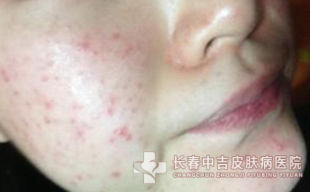 痤疮怎么预防会更合适