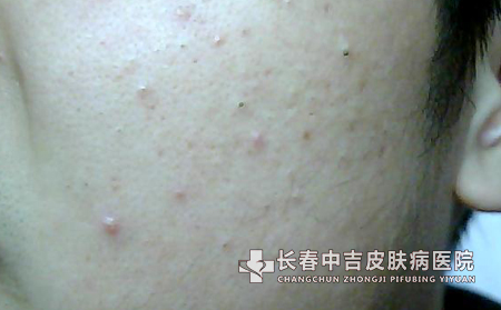 痤疮应该如何预防？