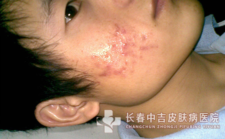 预防痤疮的有效措施