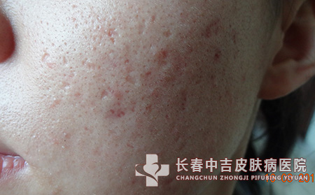 痤疮的护理工作怎样进行