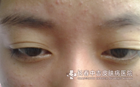 痤疮的日常护理方法