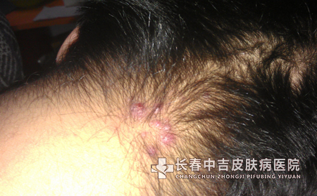 家庭护理痤疮的方法