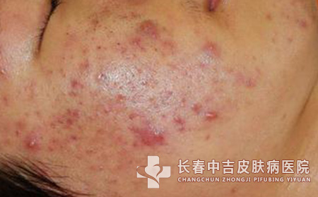 对痤疮有效的护理方法
