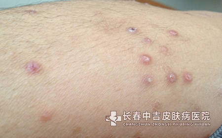 认识湿疹