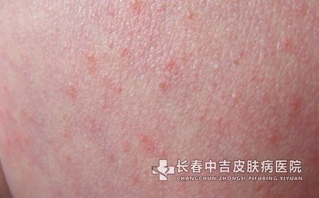 湿疹的严重程度分类