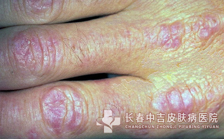 皮肌炎并发症
