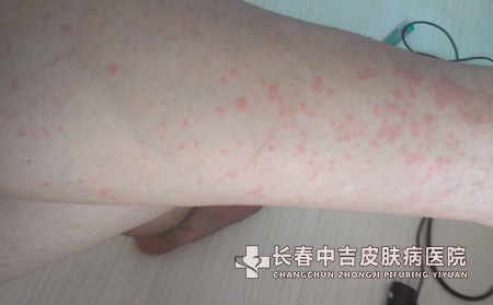 湿疹的并发症