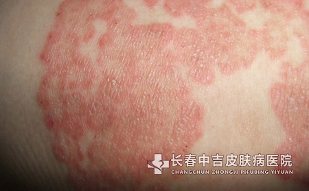 湿疹的治疗方法