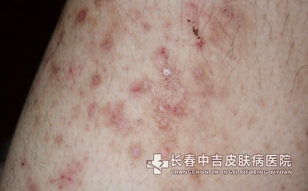 湿疹的临床症状