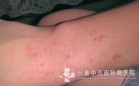皮炎并发症