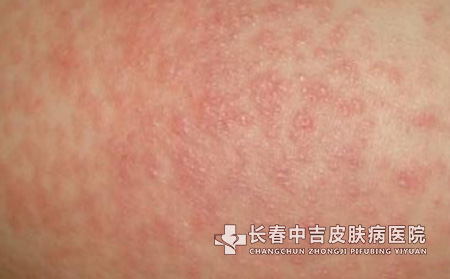 认识神经性皮炎
