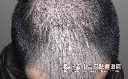 认识脱发