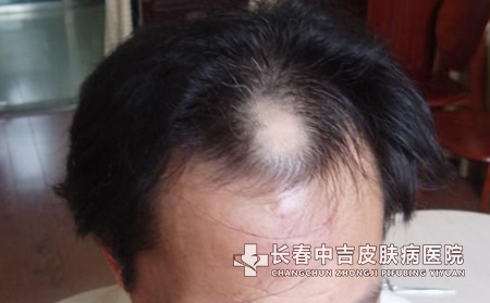 脱发并发症