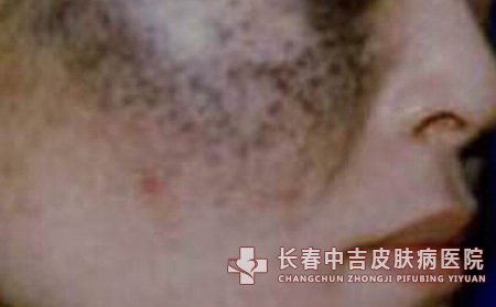 严重程度分类