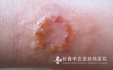 认识体癣