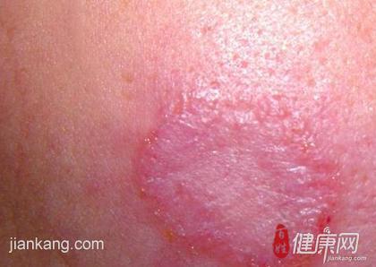 临床症状