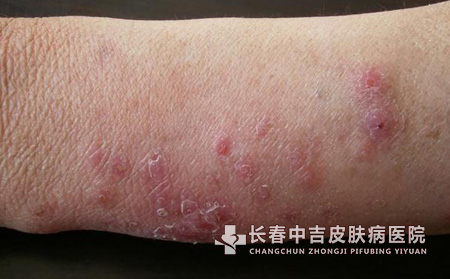 严重程度分类