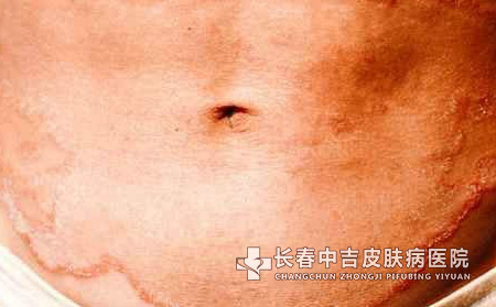体癣并发症