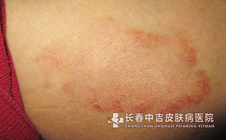治疗方法