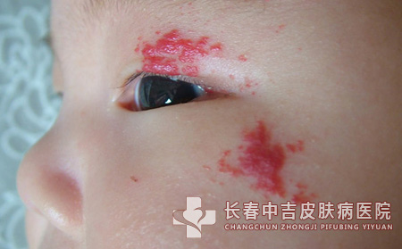 临床症状