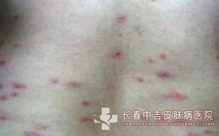 荨麻疹