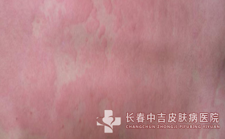 荨麻疹