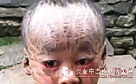 鱼鳞病并发症