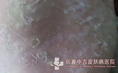 足癣