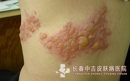 带状疱疹的症状表现是什么？