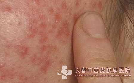 溢脂性皮炎