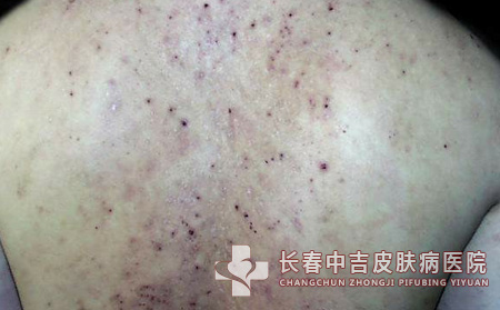 溢脂性皮炎