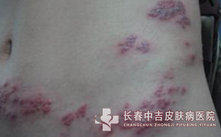 治疗带状疱疹有什么不错方法？