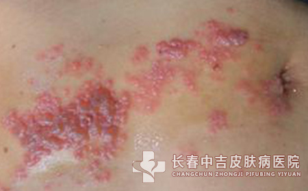 带状疱疹难治不错吗？