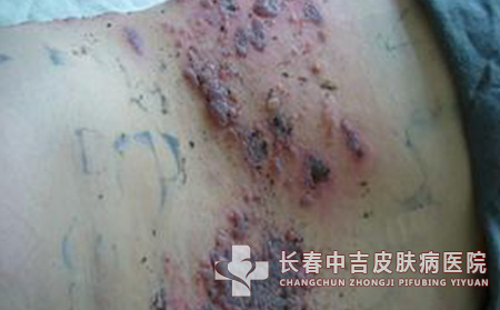 带状疱疹病人需要注意哪些问题？