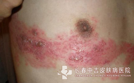 注意：秋季多发四种皮肤病