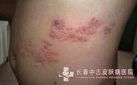 护理带状疱疹病人注意什么？